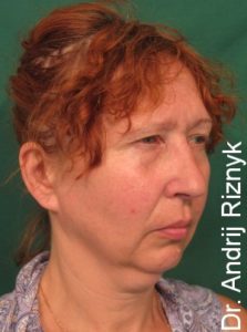 підтяжка лиця львів