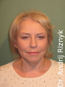 пластика обличчя фото