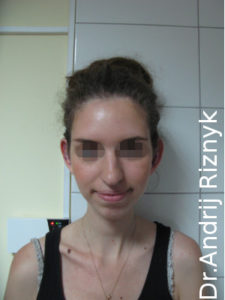 отопластика