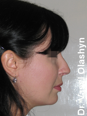 ринопластика операции