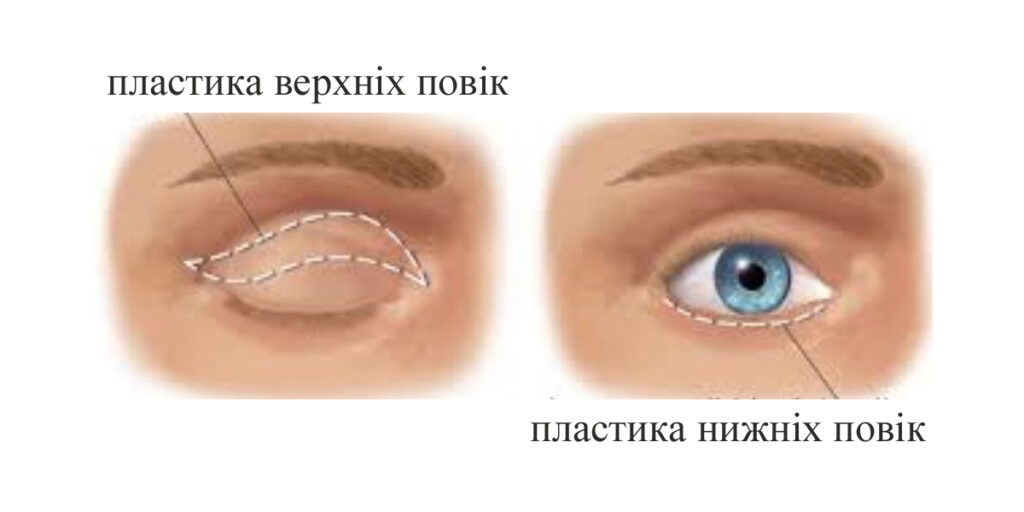 пластика нижніх повік. пластика верхніх повік